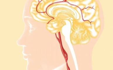 赴日看病机构医学专家解析脑出血是否能完全康复